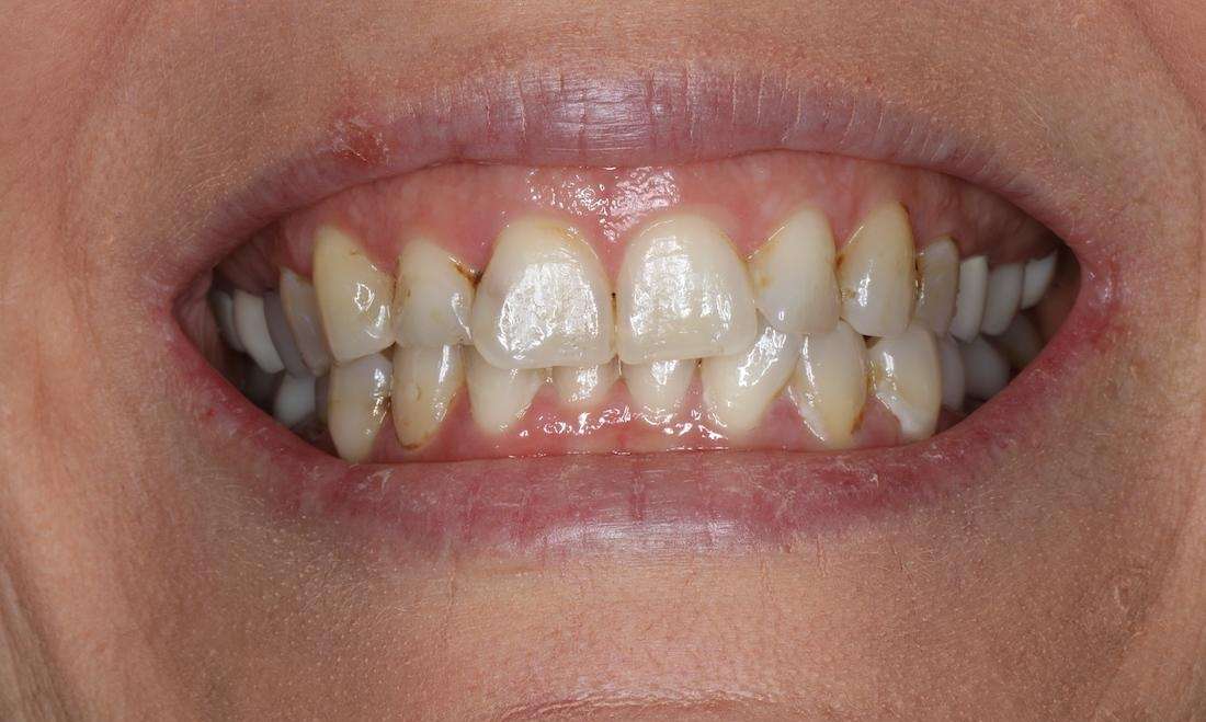 Close up of womans smiling before cosmetic crowns, brentwood tn
