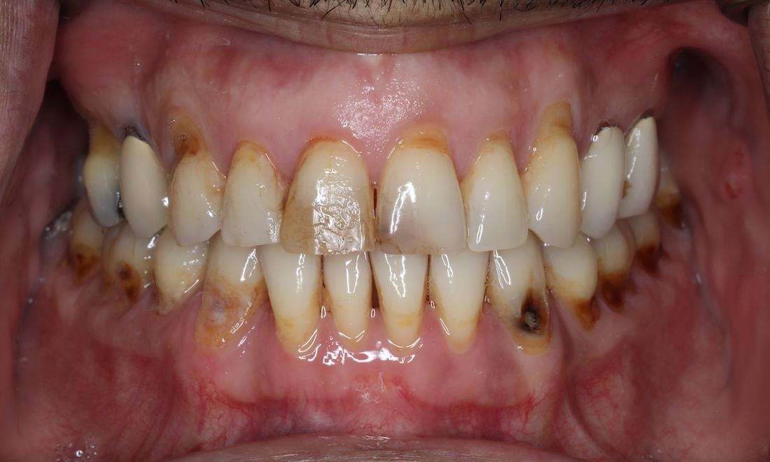 Close up of mans gums before cosmetic crowns, brentwood tn