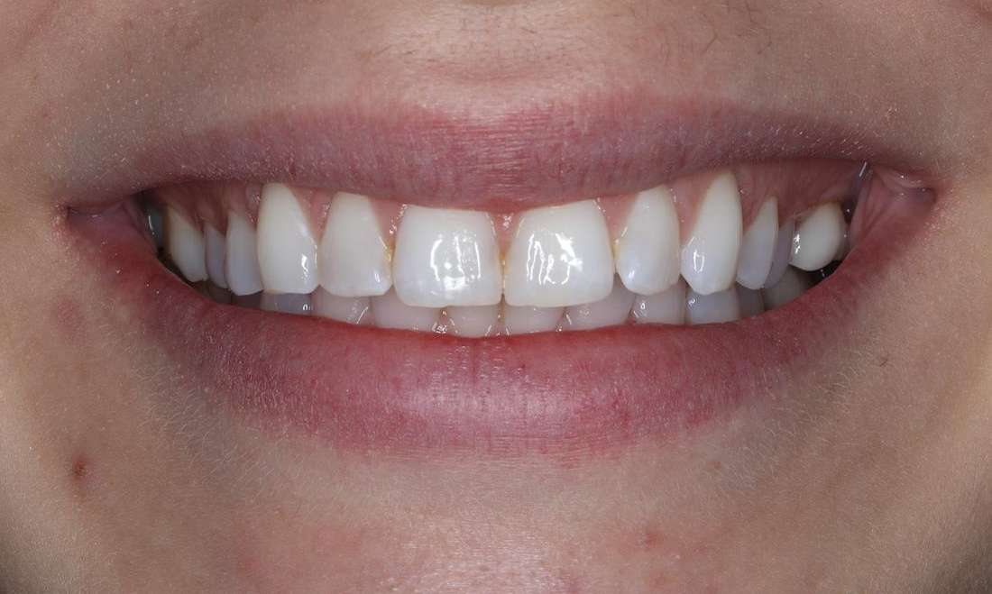 Close up of womans mouth before getting cosmetic/cerec crowns in brentwood, tn