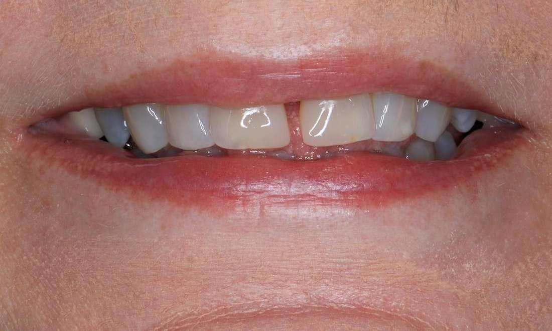 Close up of an older woman before CEREC cosmetic crowns, brentwood tn