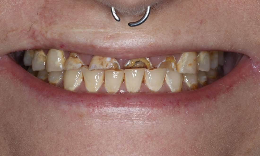 Close up view of before full mouth smile makeover, nashville tn