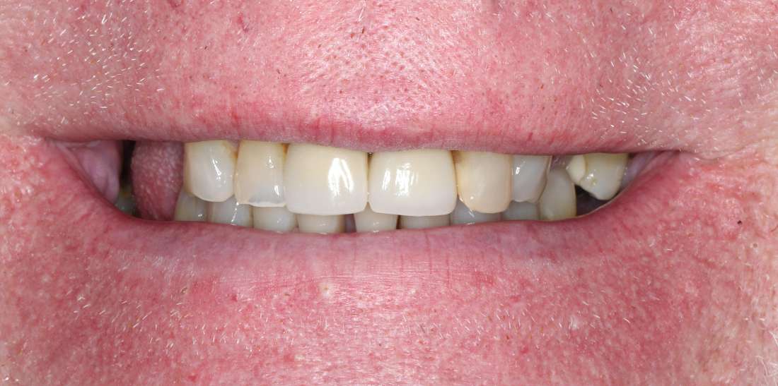 Close up of man smiling before full smile makeover, nashville tn