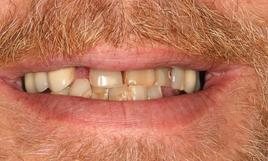 Close of mans mouth with mustache before implant-supported dentures, Nashville tn