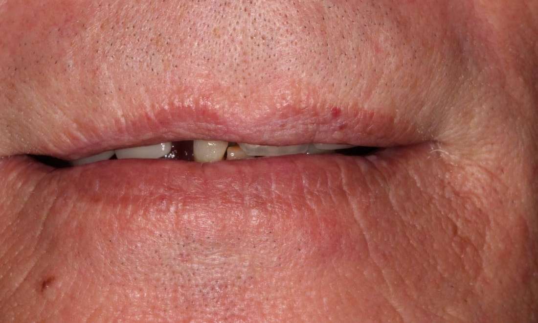 Mouth before Upper and Lower Implant-Supported Dentures, nashville tn