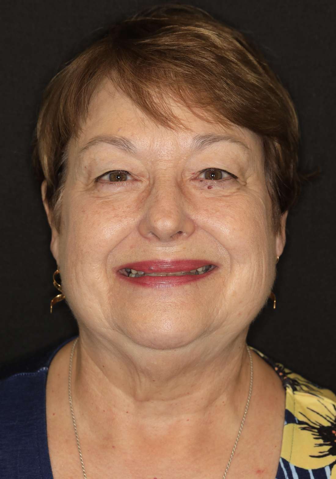 Older woman with brown hair before cosmetic crowns, brentwood tn