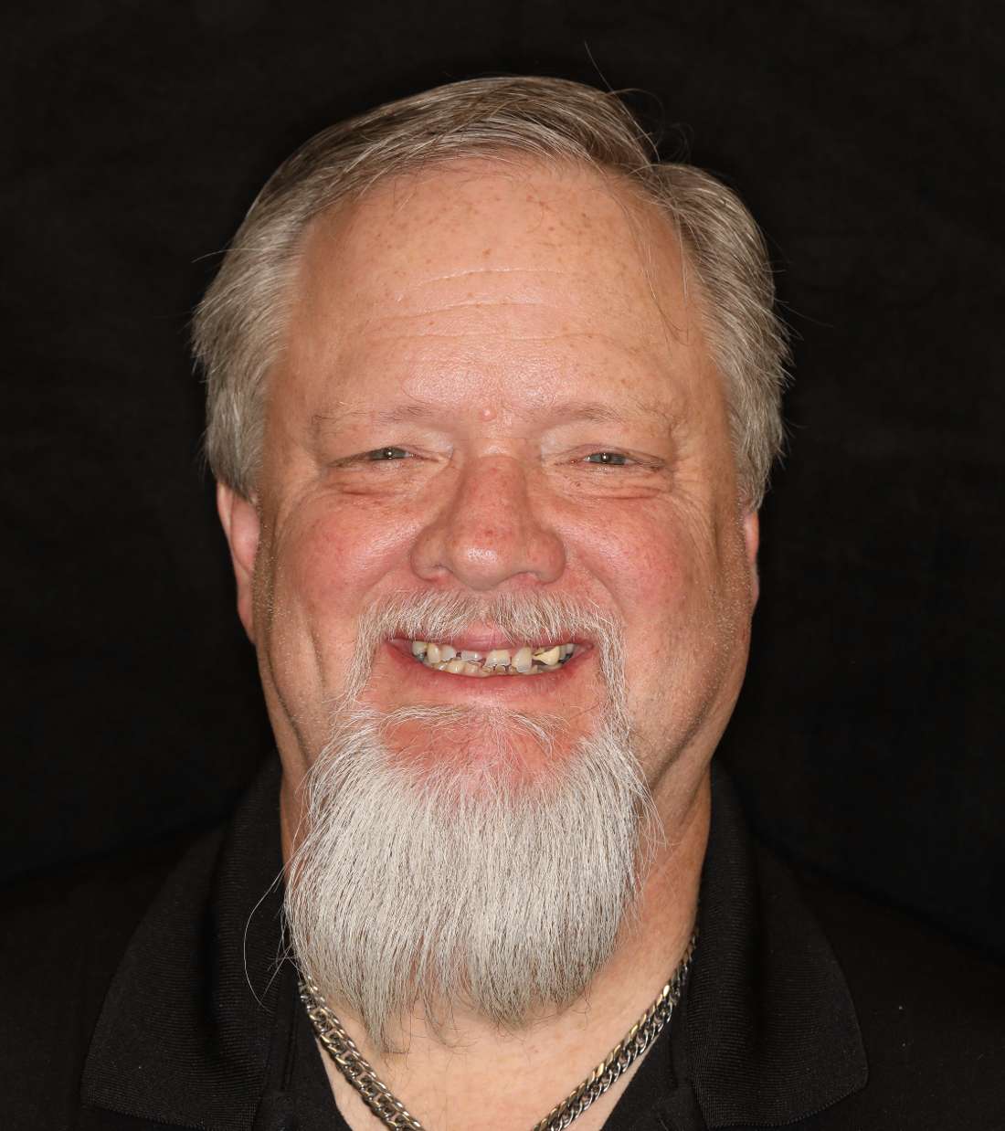 Implant Dentures, Nashville- Before Photo