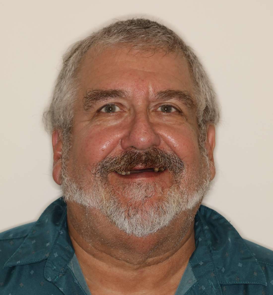 Dentures in Brentwood, TN- Before Photo