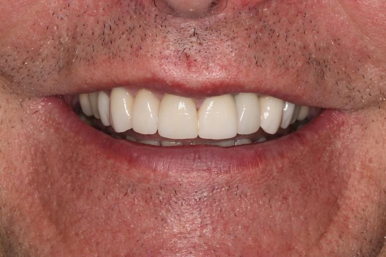 man smiling after veneers in nashville, tn