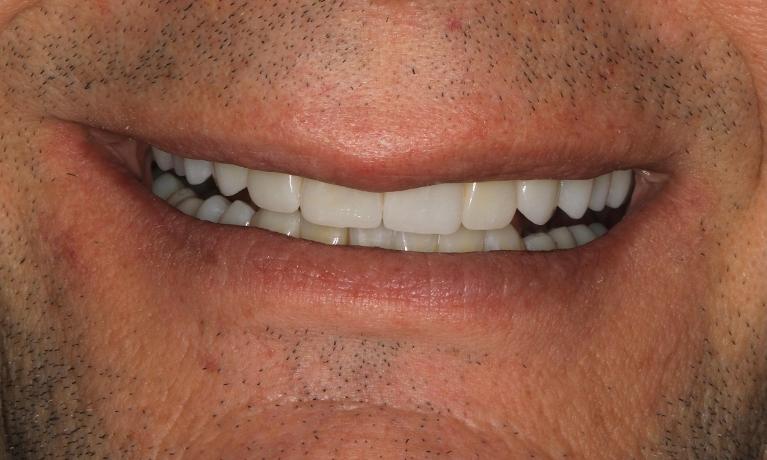smile after full mouth rehab in brentwood