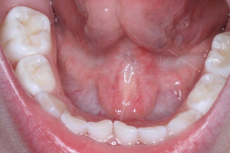 Lip and tongue tie treatment | Sullivan Dental Partners