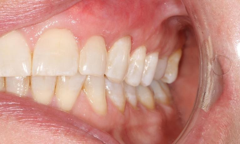 Pinhole graft for gum recession | Sullivan Dental Partners