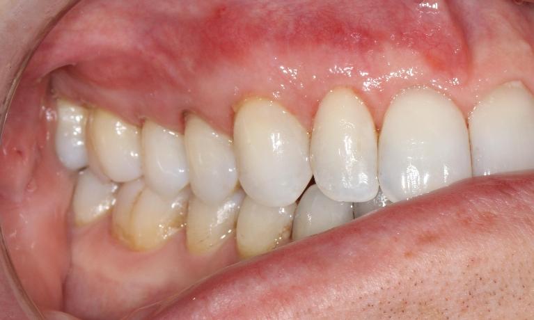 Pinhole graft for gum recession | Dentist Brentwood TN