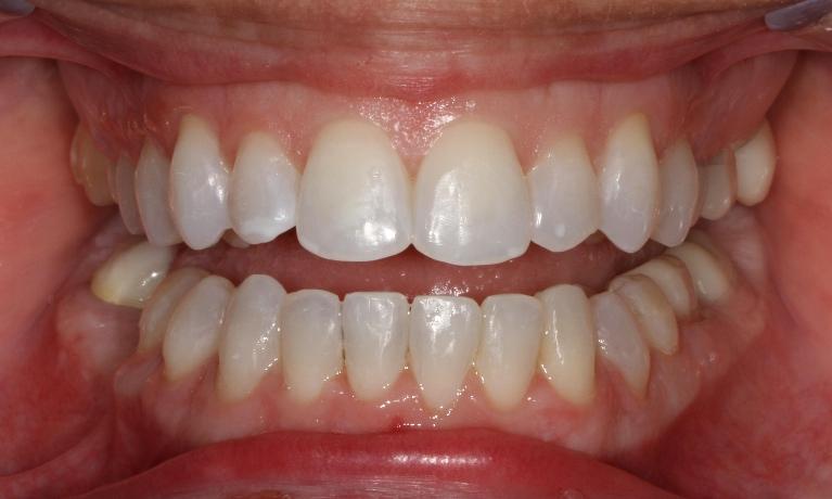 Six month smiles used to straighten teeth | Sullivan Dental Partners