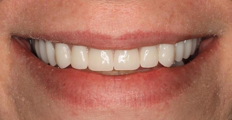 smile with dentures in nashville tn