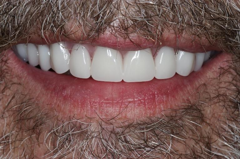 smile with dentures in nashville tn