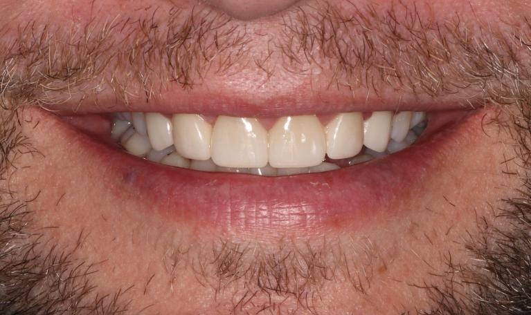 smile after upper veneers in brentwood tn