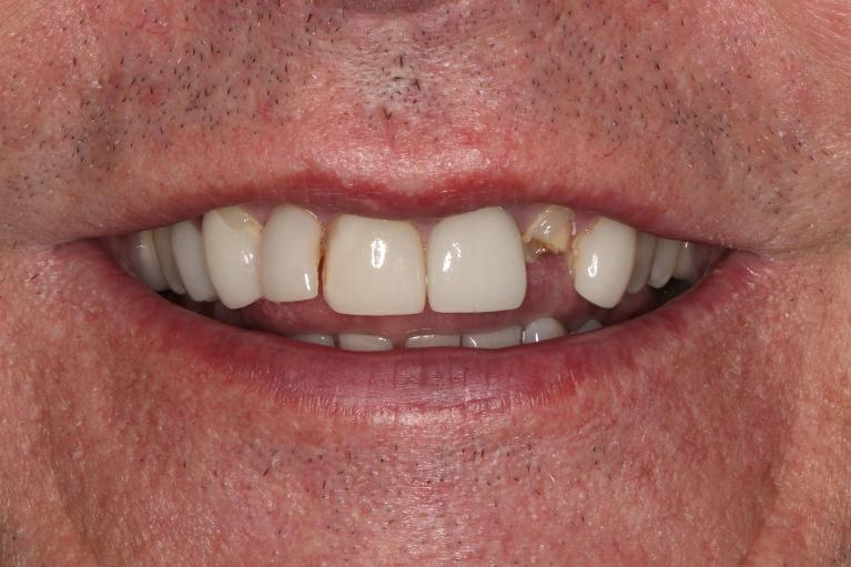 smile before veneers in nashville, tn