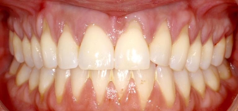 Severe gum recession | Sullivan Dental Partners