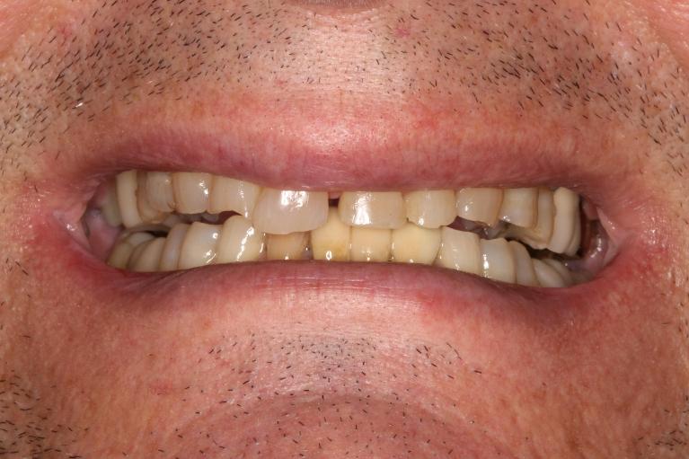 smile before full mouth rehab in brentwood