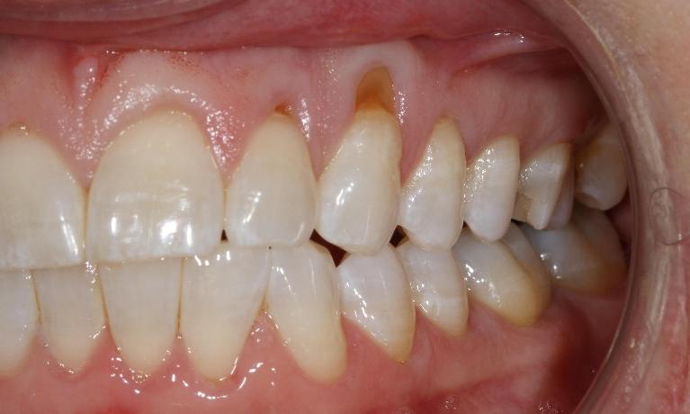 Severe gum recession | Sullivan Dental Partners