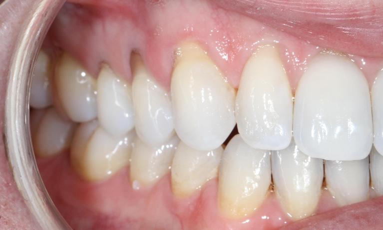 Upper right teeth with gum recession | Sullivan Dental Partners