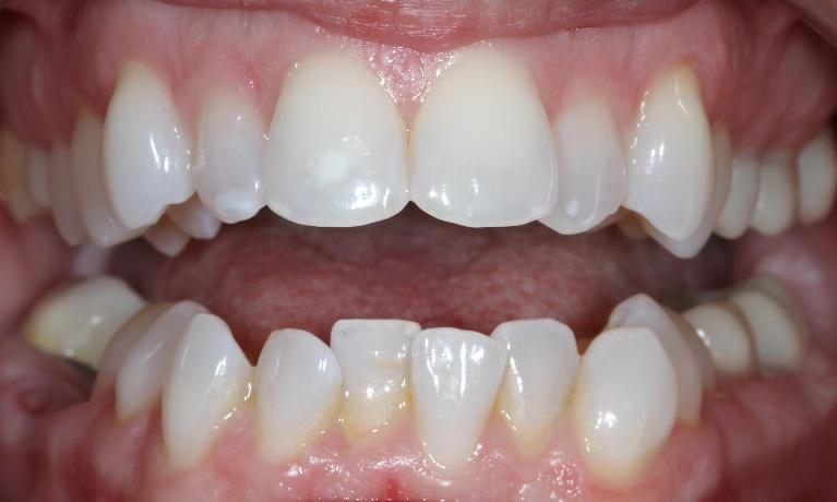 Crowding of upper teeth | Brentwood TN Dentist