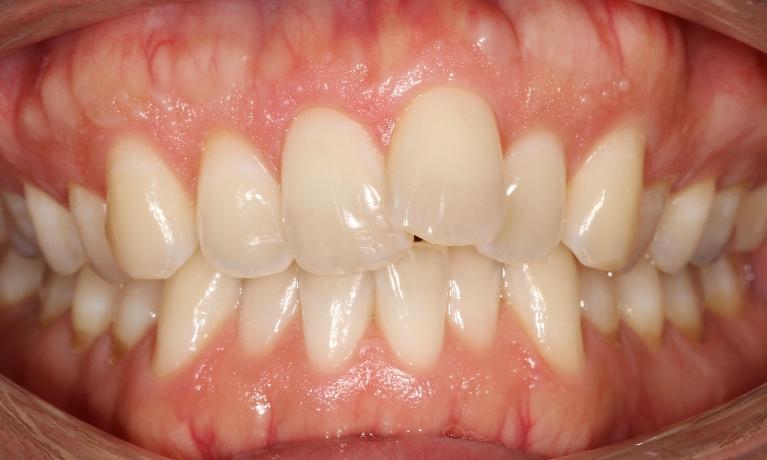 Crowded front teeth | Sullivan Dental Partners