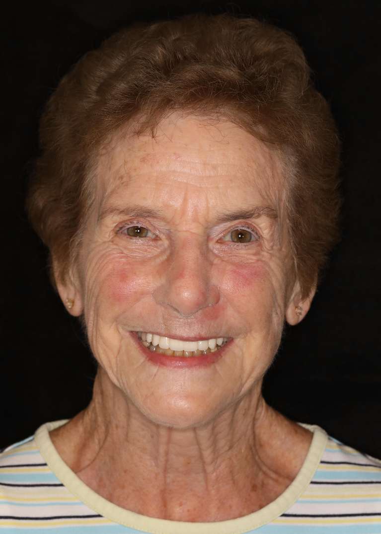 Elderly woman smiling after all-on-x implant dentures, nashville tn
