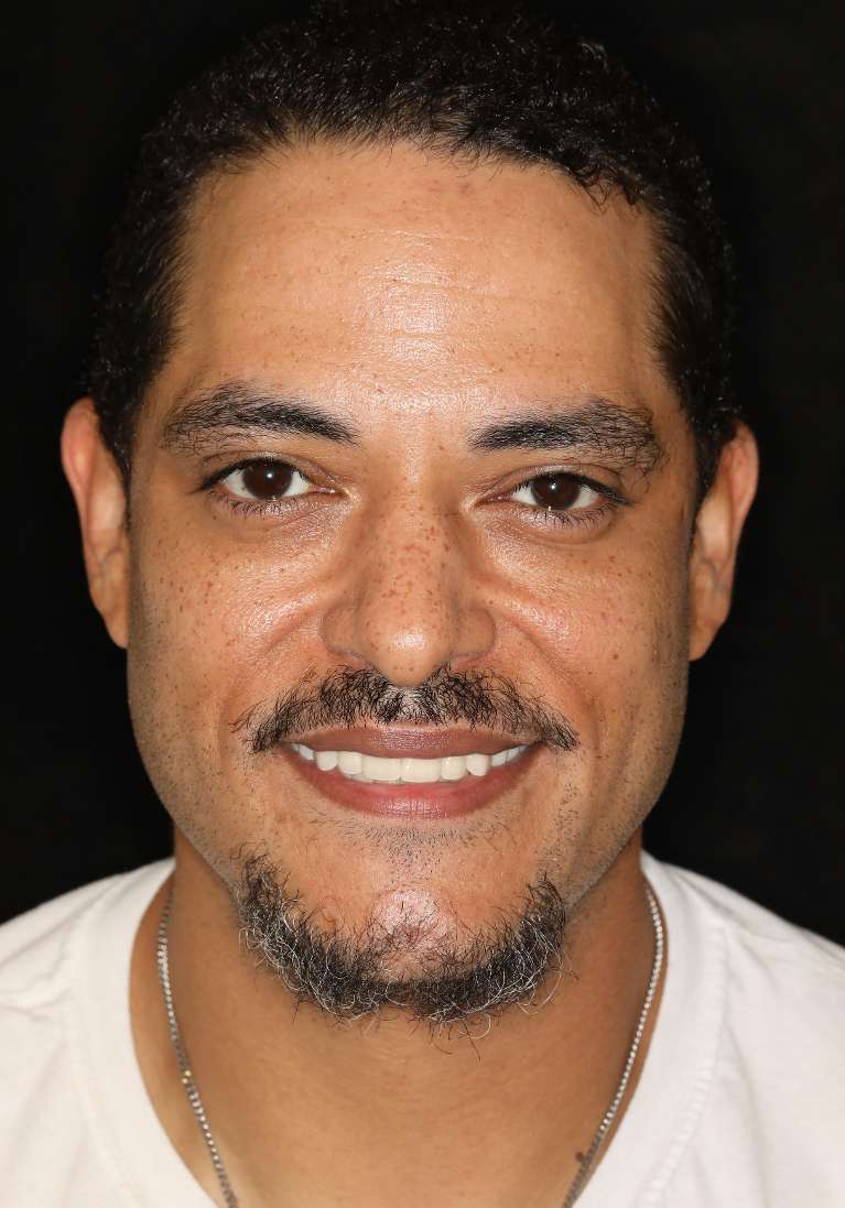 All-on-X-Implant-Dentures-After-Image