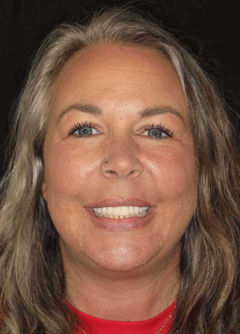 All-on-X-Implant-Dentures-After-Image