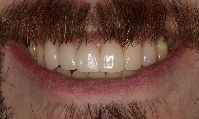 After Cosmetic Crowns and Bridges in Brentwood, TN