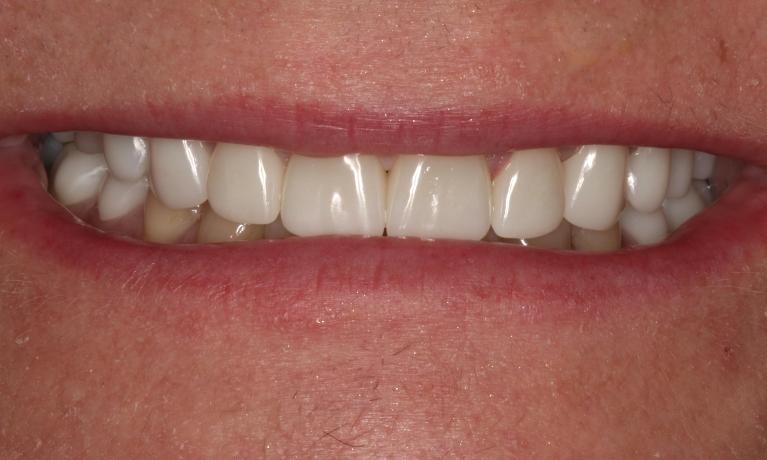 Patient after receiving crowns Brentwood, TN