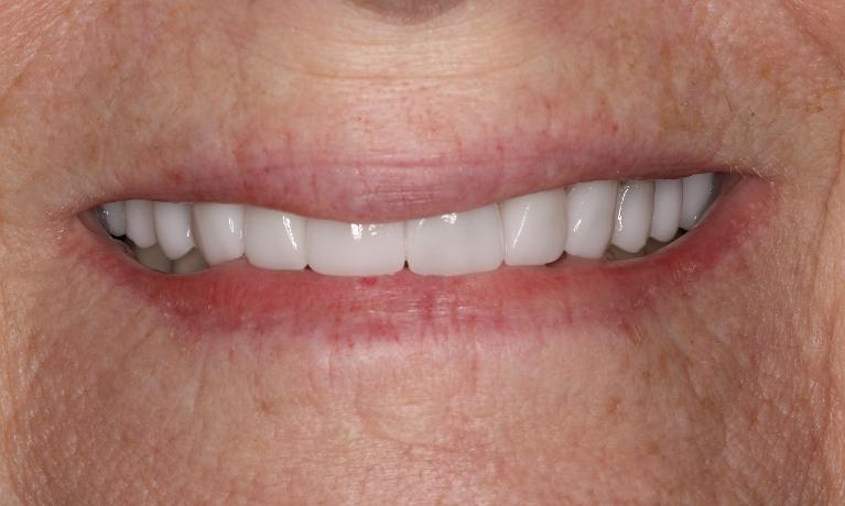 after picture of smile makeover in brentwood tn