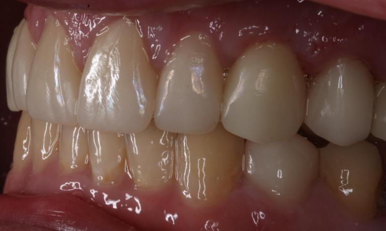 Close up of mouth from a side view after a complete smile makeover, nashville tn