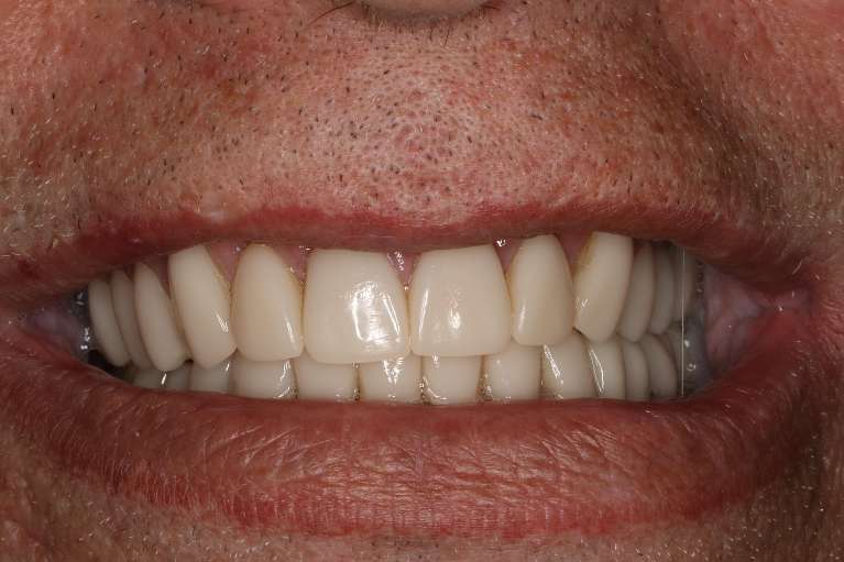 Close up of mans mouth after cosmetic crowns