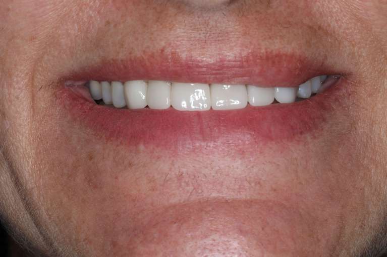Womans smile after cosmetic crowns, nashville tn