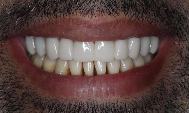 Close up of mans mouth with black facial hair after cosmetic crowns, brentwood tn