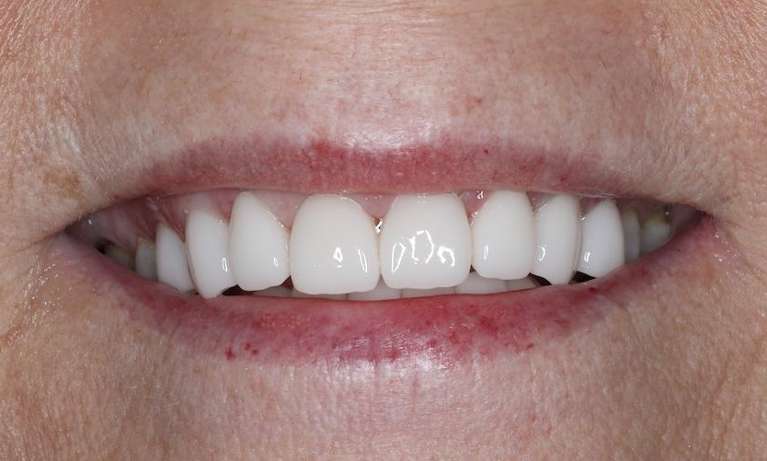 Close up of white womans mouth after cosmetic crowns, brentwood tn