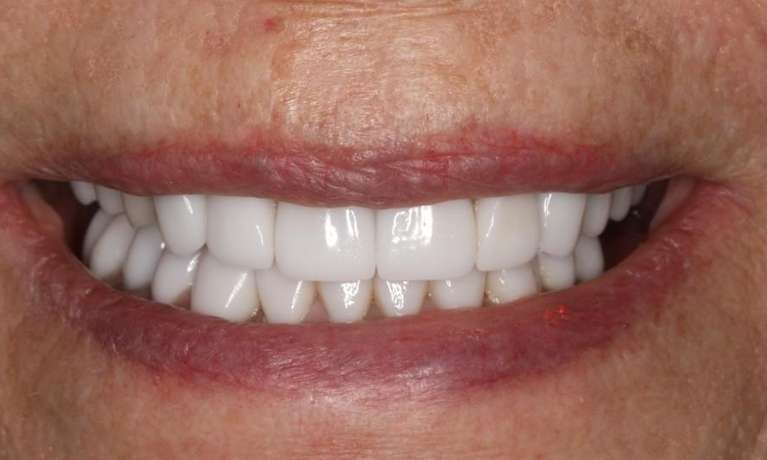 Close up view of elderly womans mouth after cosmetic crowns, brentwood tn