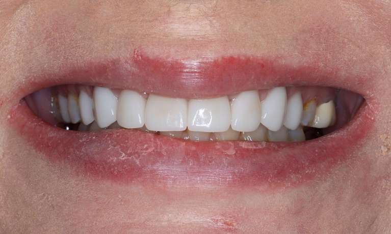 Close up of middle aged womans mouth after cosmetic crowns, brentwood tn