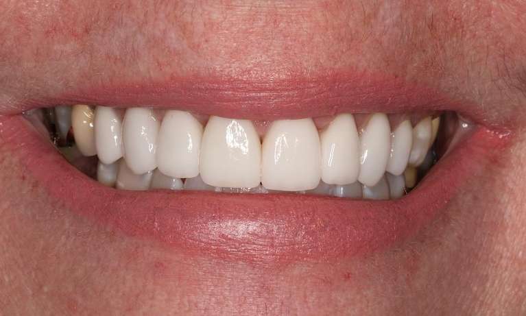 Close up view of womans mouth after cosmetic crowns, brentwood tn