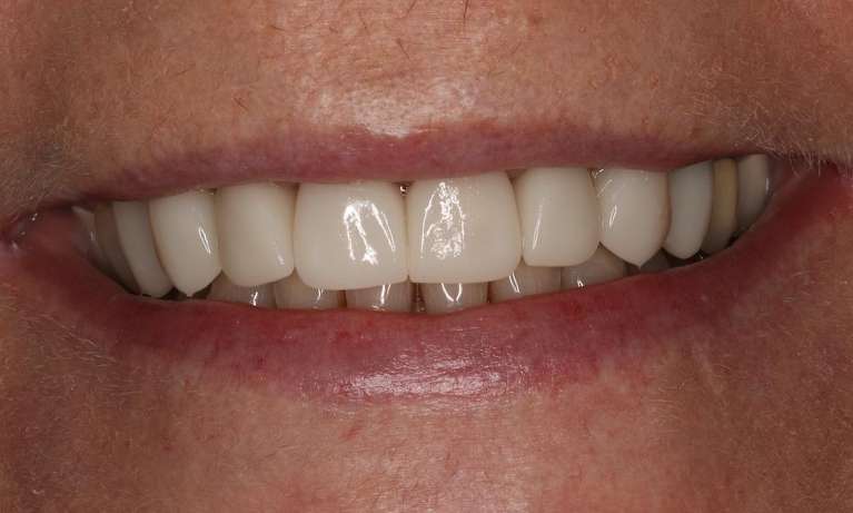 Close up of mouth after cosmetic crowns, brentwood tn