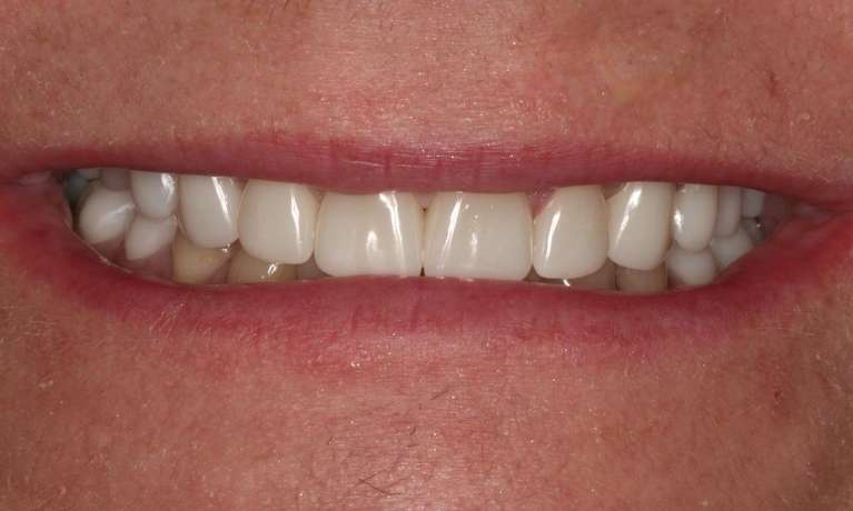 Mouth after cosmetic crowns, brentwood tn