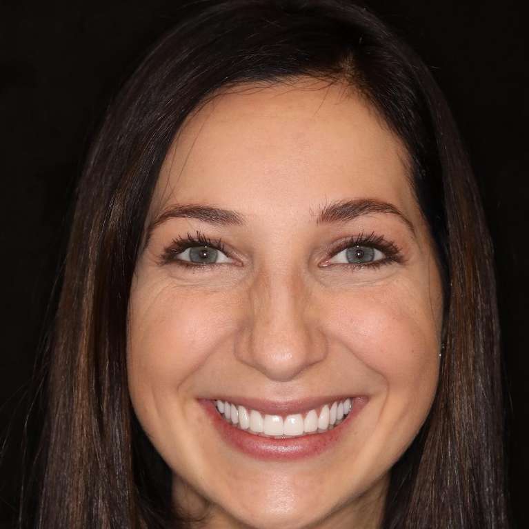 After picture of a woman getting cosmetic/cerec crowns in brentwood, tn