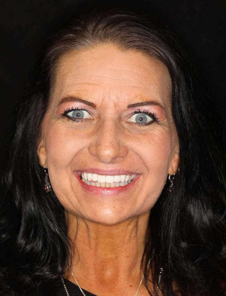 After picture of a woman getting cosmetic crowns in brentwood, tn