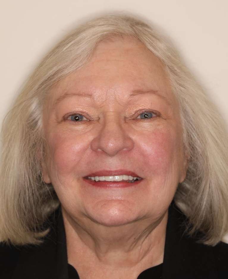 Cosmetic-Dentistry-Cosmetic-Crowns-CEREC-After-Image