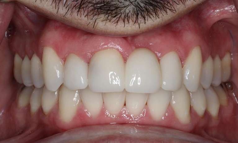 Close up of mouth after dental bridge, brentwood tn