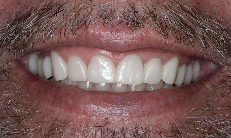 Full mouth makeover in Brentwood, TN