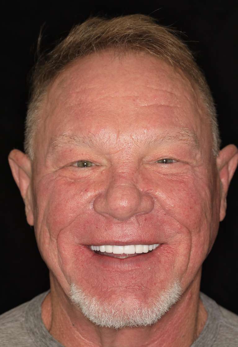 Full-Smile-Makeover-After-Image