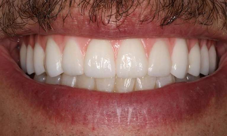 Mans mouth with a mustache after implant dentures, nashville tn